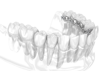 Photo for Lingual braces system. 3D illustration concept of golden braces - Royalty Free Image