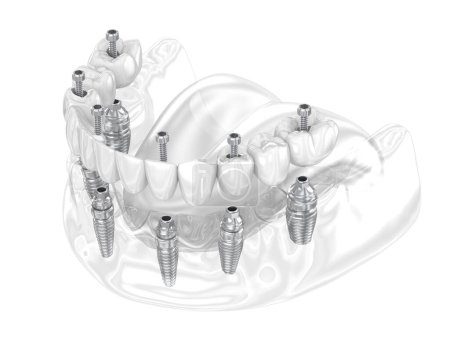 Photo for Dental prosthesis supported by six implants. Dental 3D illustration - Royalty Free Image