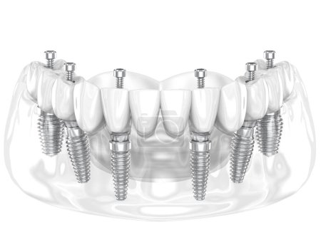 Téléchargez les photos : Prothèse dentaire soutenue par six implants. Illustration 3D dentaire - en image libre de droit