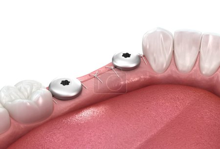 Gingiva former over implant. Medically accurate 3D illustration.