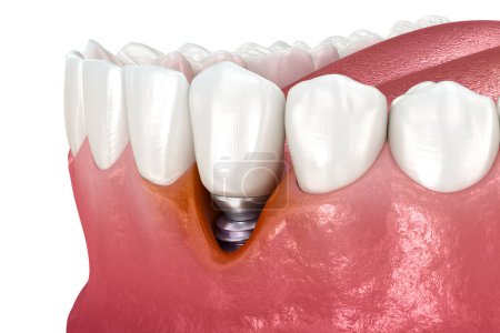 Photo for Peri-implantitis with visible gingiva recession. Medically accurate 3D illustration. - Royalty Free Image