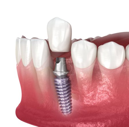 Photo for Dental implant and ceramic crown. Medically accurate tooth 3D illustration. - Royalty Free Image