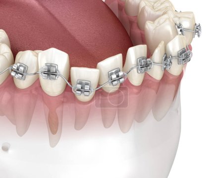 Anomale Zahnstellung und Korrektur mit Metallspangen Tretament. Medizinisch korrekte zahnärztliche 3D-Illustration