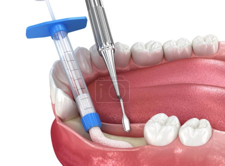 Photo for Bone grafting, augmentation. Medically accurate 3D illustration. - Royalty Free Image