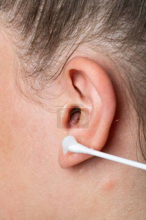 Foto de Absceso curativo Inflamación en el oído, área de supuración. Oído furúnculo. Carbunco purulento. Tratamiento del absceso. - Imagen libre de derechos