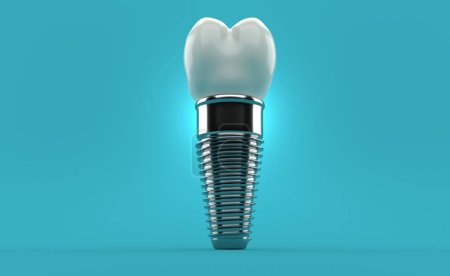 Photo for Dental implant on blue background. 3d illustration - Royalty Free Image