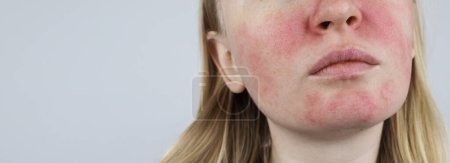 Foto de Rosacea face. The girl suffers from redness on her cheeks. Couperosis of the skin. Redness and capillary mesh are visible on the face. Treatment and removal. Vascular surgery and dermatology - Imagen libre de derechos