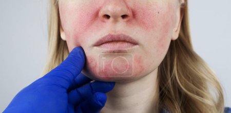 Photo for Rosacea face. The girl suffers from redness on her cheeks. Couperosis of the skin. Redness and capillary mesh are visible on the face. Treatment and removal. Vascular surgery and dermatology - Royalty Free Image