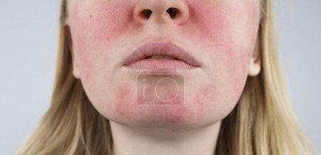 Téléchargez les photos : Rosacea face. The girl suffers from redness on her cheeks. Couperosis of the skin. Redness and capillary mesh are visible on the face. Treatment and removal. Vascular surgery and dermatology - en image libre de droit