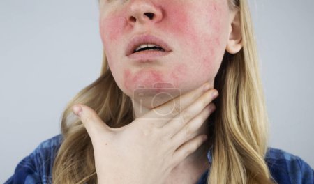 Photo for Rosacea face. The girl suffers from redness on her cheeks. Couperosis of the skin. Redness and capillary mesh are visible on the face. Treatment and removal. Vascular surgery and dermatology - Royalty Free Image