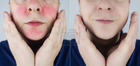 Photo for Rosacea face. The man suffers from redness on her cheeks. Couperose of the skin. Redness and capillary mesh are visible on the face. Treatment and removal. Vascular surgery and dermatology - Royalty Free Image