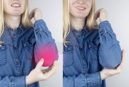 Photo for Before and after. Elbow pain. Girl shows consequences of tennis injury, overexertion, bone fractures, consequences of blow, microtrauma or arthritis. On right girl shows no more inflammation and pain - Royalty Free Image