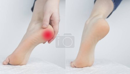 Photo for Before and after. Woman suffering from heel pain. Inflammation or sprain of the tendon in the foot, heel spur, bursitis. Concept of diseases and pains in the leg. On right photo no pain - Royalty Free Image