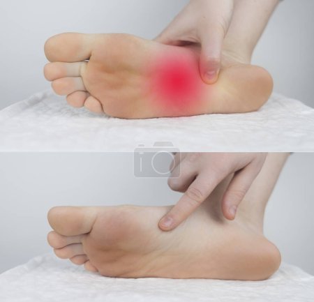 Photo for Before and after. Sole of the foot pain, tendon sprains, inflammation, flat feet, bursitis, fasciitis. Disease treatment concept. On left, she found an injury, on right, she had already been cured - Royalty Free Image
