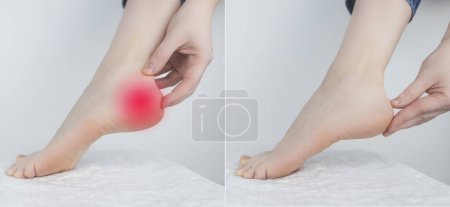 Téléchargez les photos : Avant et après. Femme souffrant de douleur au talon. Inflammation ou entorse du tendon dans le pied, éperon du talon, bursite. Concept de maladies et de douleurs dans la jambe. Sur la photo de droite aucune douleur - en image libre de droit
