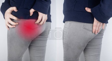 Before and after. A woman suffers from pain in the buttock. The doctor diagnoses the patient piriformis syndrome, pinch of the sciatic nerve, lumbar osteochondrosis or sciatica