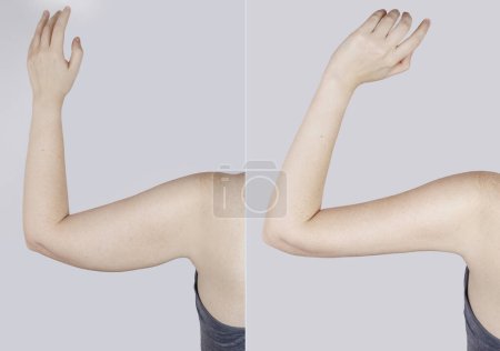 Photo for Obesity Cellulite. Sagging flabby skin on a woman arm. Before and after. Concept of losing weight, playing sports, checking result from diet and intense training. Result of losing weight. Liposuction - Royalty Free Image