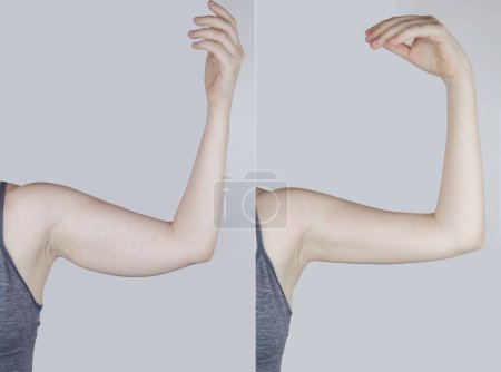 Obesidad Celulitis. Caída de la piel flácida en un brazo de mujer. Antes y después. Concepto de perder peso, practicar deportes, comprobar el resultado de la dieta y el entrenamiento intenso. Resultado de perder peso. Liposucción