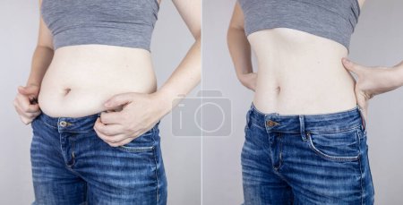 Photo for Obesity Cellulite. Folds of excess fat on woman waist. Before and after. Concept of losing weight, playing sports, checking result from diet and intense training. Result of losing weight. Liposuction - Royalty Free Image