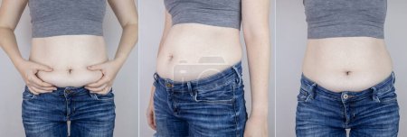 Photo for Obesity Cellulite. Folds of excess fat on woman waist. Before and after. Concept of losing weight, playing sports, checking result from diet and intense training. Result of losing weight. Liposuction - Royalty Free Image