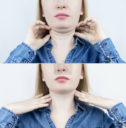 Téléchargez les photos : Ascenseur double menton chez les femmes. Photos avant et après la chirurgie plastique, la génoplastie ou la construction du visage. Enlèvement de la graisse du menton et correction du contour du visage. Graisse sous-cutanée, perte d'élasticité, affaissement - en image libre de droit