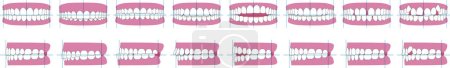 Tipos de alineación dental y maloclusión. Ilustración del vector frontal y lateral