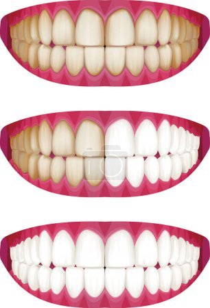 Hermosos dientes blancos y dientes manchados Placa