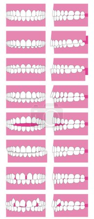 Types of tooth alignment and malocclusion. Front and side vector illustration