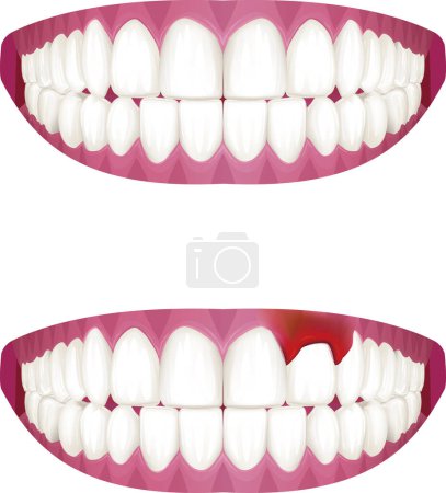 Illustration for Clean gums and swollen symptomatic gums vector illustration - Royalty Free Image