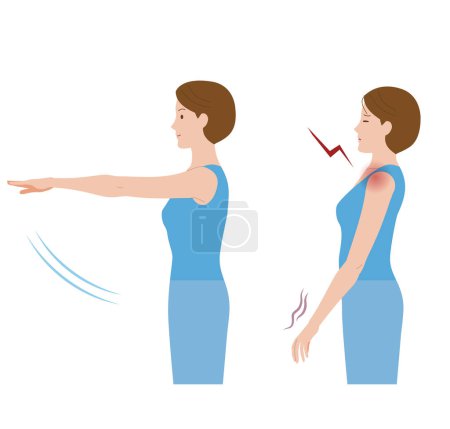 Una mujer cuyo hombro duele debido a la congelación del hombro y la periartritis y no puede mover su mano hacia adelante.