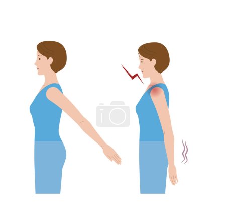 Una mujer cuyo hombro duele debido a la congelación del hombro y la periartritis y no puede mover la mano hacia atrás.