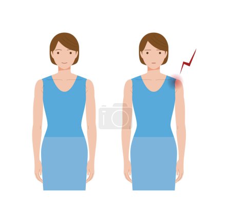 Illustration for A woman suffering from shoulder pain due to frozen shoulder, frozen shoulder, frozen shoulder, and periarthritis. - Royalty Free Image