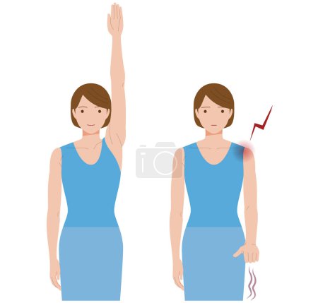 Una mujer cuyo hombro duele debido a la congelación del hombro y la periartritis y no puede levantar la mano.