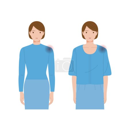 Schulterschmerzen durch eingefrorene Schulter oder Periarthritis. Frauen tragen lockere und eng anliegende Kleidung