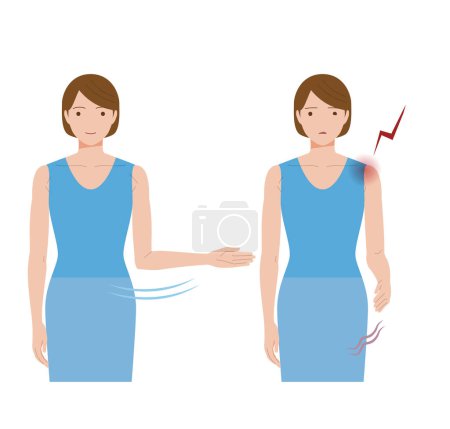 Eine Frau, deren Schulter aufgrund von eingefrorener Schulter und Periarthritis schmerzt und die ihre Hand nicht zur Seite öffnen kann.