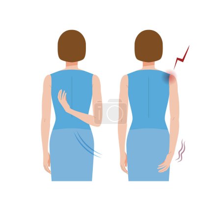 Eine Frau, deren Hände sich wegen eingefrorener Schultern und Periarthritis nicht hinter ihrem Rücken bewegen können.
