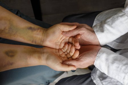 Photo for Bruise on the patient's arm and doctor's hand closeup. Aid, medicine and treatment for patient concept - Royalty Free Image