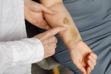 Photo for Large bruise on human arm. Injection bruises. Doctor and patient indoor - Royalty Free Image