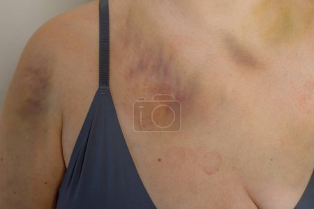 Photo for Female body with car accident bruise - Royalty Free Image