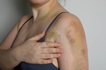 Photo for Female shoulder with car accident bruise - Royalty Free Image