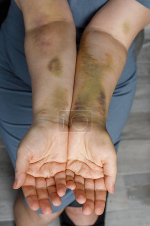 Photo for Woman hand with car accident bruise - Royalty Free Image