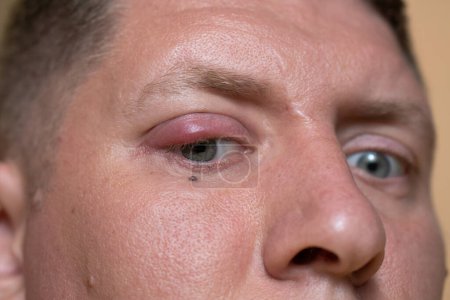 Photo for Chalazion behind the eye Evely's infection - Royalty Free Image