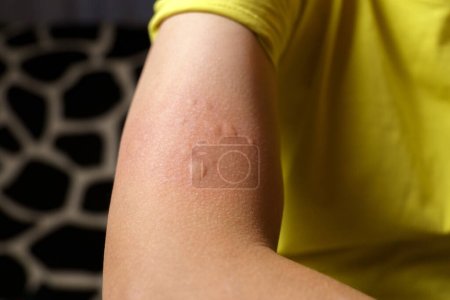 Photo for Allergy symptoms, after injection. Edematous part, red puncture site. - Royalty Free Image