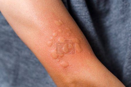 Allergiespritze auf die Haut. Mann Hand aus nächster Nähe, selektiver Fokus