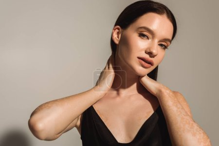 Hübsches junges Modell mit Vitiligo berühren Hals und Blick auf Kamera auf grauem Hintergrund 