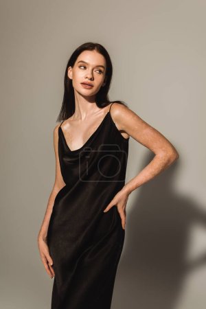 Foto de Elegante modelo con vitiligo en vestido de seda negro de pie con la mano en la cadera sobre fondo gris - Imagen libre de derechos