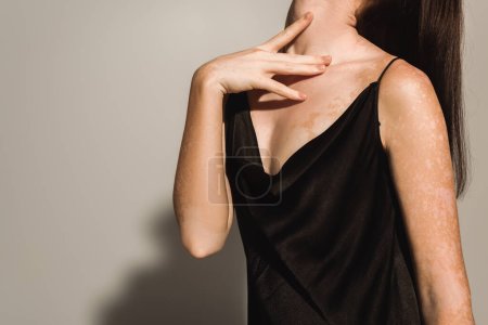 Cropped view of woman with vitiligo touching neck on grey background 