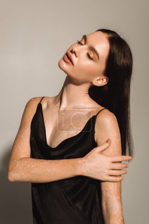 Hübsche Frau mit Vitiligo, die Augen schließt und den Arm auf grauem Hintergrund berührt 