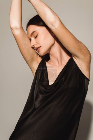 Sinnliches Modell mit Vitiligo posiert im schwarzen Kleid auf grauem Hintergrund 