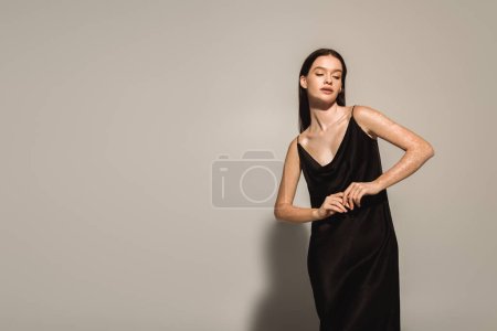 Photo for Trendy woman with vitiligo posing in black camisole on grey background - Royalty Free Image